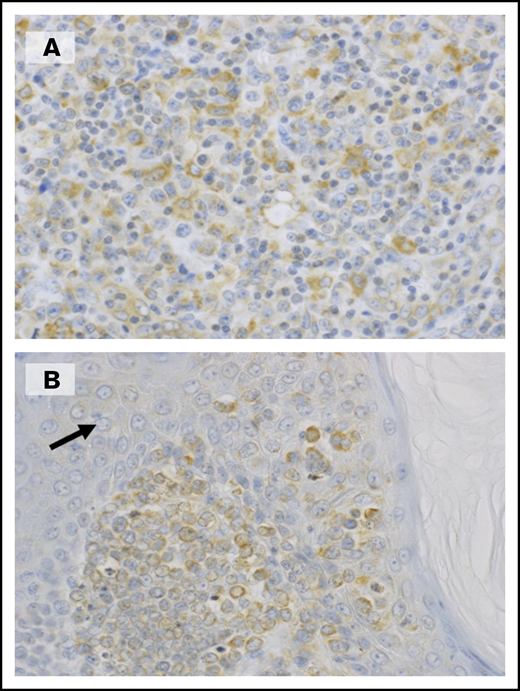 Expression of TNFR2 in tumor cells from ATL patients. (A) A biopsied lymph node shows numerous atypical large lymphoid cells positive for TNFR2. (B) In this skin lesion, infiltrating tumor cells were positive for TNFR2, whereas epithelial cells (arrow) were negative. (A-B) Original magnification ×400, immunostaining with polyclonal antibodies against TNFR2.