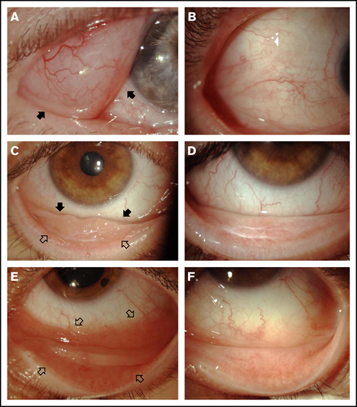 Three examples of responses after intralesional rituximab. (A) Right eye: extensive infiltration of bulbar temporal conjunctiva of a lymphomatous mass with well-defined margins (arrows); the therapeutic target was well delimited. (C) Right eye: tumor infiltration of the inferior conjunctiva; the lesion of the bulbar conjunctiva was better defined (solid arrows), whereas infiltration of the palpebral conjunctiva was poorly delimited (open arrows). (E) Left eye: extensive infiltration of bulbar and palpebral inferior conjunctiva with intense hyperemia that hampered the definition of the borders of the lesion (open arrows) and required numerous subconjunctival injections of rituximab to avoid undertreatment. (B,D,F) Tumor regression after intralesional injections of rituximab.