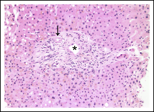 Portal tract containing a narrowed portal venule (asterisk), which is barely larger than the nearby arteriole (arrow; hematoxylin and eosin stain).
