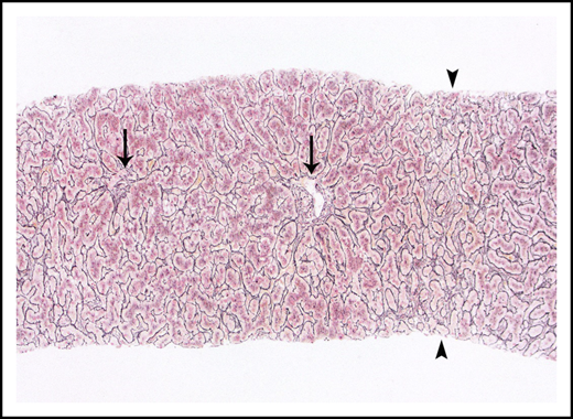 Nodular regenerative hyperplasia pattern by reticulin stain, which serves to outline hepatic cords. Hepatic cords are thickened around the portal tracts (arrows) and are atrophic in zone 3 (arrowheads).