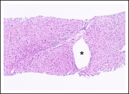 An aberrant periportal venule (asterisk) extends beyond the confines of the portal tract (hematoxylin and eosin stain).