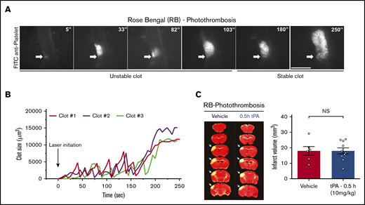 The RB photothrombotic stroke model induces platelet aggregates and responds to tPA-lytic treatment poorly. (A) Single vessel-directed RB photothrombosis induced a train of initially unstable platelet clots that transformed into rapidly expanding platelet aggregates, as shown by intravital microscopy using DyLight488-conjugated anti-GPIbβ antibody (arrow indicates the site of 20-μm diameter laser photoactivation; also see supplemental Video 1). Scale bar, 50 μm. (B) Tracing of the size of 3 photoactivation-induced platelet aggregates under single-vessel RB-PTS over time. The initial platelet clots were repeatedly flushed away by the blood flow until the later clot adhered to the endothelial wall and expanded in size rapidly (n = 3). (C) Intravenous application of 10 mg/kg tPA at 30 minutes after the proximal MCA branch-directed RB-PTS failed to reduce the infarct size. The TTC-unstained infarcted area (indicated by arrows) was 18 ± 1.95 mm3 in tPA-treated mice (n = 10) and 18 ± 2.80 mm3 in the vehicle-treated mice (n = 6) at 24 hours recovery. P > .05 by unpaired Student t test. Shown are the mean ± standard error of the mean. NS, not significant.