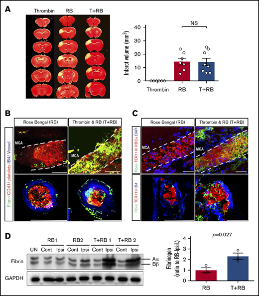 T+RB-PTS produces a greater fibrin content in the ensuing clots than RB-PTS. (A) A similar size of infarction was induced by RB (14.4 ± 2.50 mm3; n = 7) or Thrombin-RB (T+RB) photothrombosis (14.1 ± 2.84 mm3; n = 8), whereas photoactivation after systemic intravenous application of thrombin failed to induce cerebral infarct (n = 6). (B-C) Histological analysis of MCA showed a higher content of fibrin (green colored) in blood clots after T+RB photothrombosis than RB photothrombosis, as shown by co-immunostaining of fibrin(ogen)/CD41 (platelets; B), and fibrin/TER119 (RBCs; C) (n = 3 for each group). The transverse sections of MCA (bottom rows) were costained with isolection-B4 (IB4) to outline the vascular lumen. Note the occlusion of the whole vessel, similar to the FeCl3-induced stroke model.30 Scale bars, 50 μm. (D) Immunoblot analysis indicated greater fibrin deposits in the ipsilateral hemisphere at 2 hours after the T+RB than the RB photothrombosis stroke model. Two representative samples are shown here, as well as the quantification of 3 mice for each model (P = .027 by unpaired Student t test). Cont, contralateral hemisphere; Ipsi, ipsilateral hemisphere; UN, uninjured sham mice.