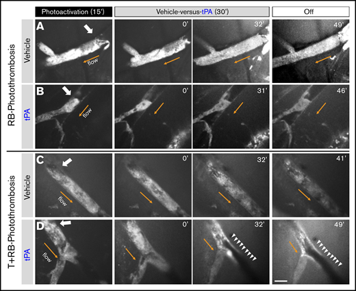T+RB-PTS is markedly more sensitive to tPA-lytic treatment than RB-PTS. (A-B) Intravital microscopy imaging with DyLight488-conjugated anti-GPIbβ/platelet antibody was used to visualize the clot behaviors during and after vehicle-vs-tPA (10 mg/kg) infusion in single-vessel RB photothrombosis model. Shown are the representative images of the RB clot with the vehicle (A; see also supplemental Video 8; n = 3) or tPA infusion (B; supplemental Video 9; n = 4). Neither tPA or vehicle induced obvious recanalization in the RB photothrombosis model. White arrow indicates the site of photoactivation (20 μm in diameter). Orange arrow indicates the direction of arterial blood flow. (C-D) The same intravital imaging method was used to compare the clot responses to vehicle-vs-tPA (10 mg/kg) infusion after T+RB photothrombosis. The vehicle treatment failed to restore the blood flow (C; supplemental Video 10; n = 3), whereas every tPA-treated mouse manifested recanalization of the occluded artery (arrowheads in D; supplemental Video 11; n = 5). Scale bar, 50 μm.