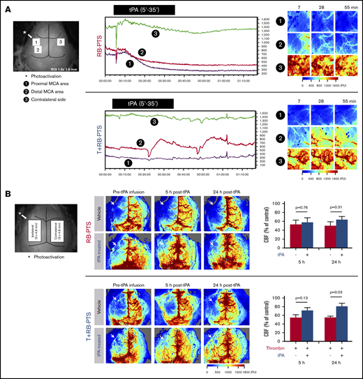 T+RB-PTS shows better recovery of CBF after tPA-lytic treatment than RB-PTS. (A) Comparison of CBF responses to 10 mg/kg tPA treatment at 30 minutes after photoactivation by LSCI in the proximal MCA-directed RB (n = 4) vs T+RB (n = 3) PTS (asterisk indicates the photoactivation site; white arrow indicates the direction of MCA blood flow). Shown are the typical CBF-tracing and LSCI images of blood flow in the proximal MCA-supplying territory (1), the distal MCA territory (2), and the contralateral hemisphere (3; area size: 1.6 mm × 1.6 mm for each). Note the stepwise CBF elevation in the distal, but not the proximal, MCA territory, in the T+RB-PTS model after tPA infusion. In contrast, the tPA treatment failed to produce CBF recovery in the RB-PTS model. (B) Comparison of CBF recovery at 5 and 24 hours after tPA infusion at 30 minutes postphotoactivation in the RB-PTS and T+RB-PTS model (the area size for LSCI measurement: 3 mm × 4.8 mm). The tPA treatment failed to improve CBF recovery compared with the infusion of vehicle at 5 or 24 hours postphotoactivation (n = 4). In contrast, the same tPA treatment produced ∼14% more CBF recovery at 5 hours (P = .13) and ∼25% more at 24 hours in the T+RB-PTS model (P = .03; n = 6).