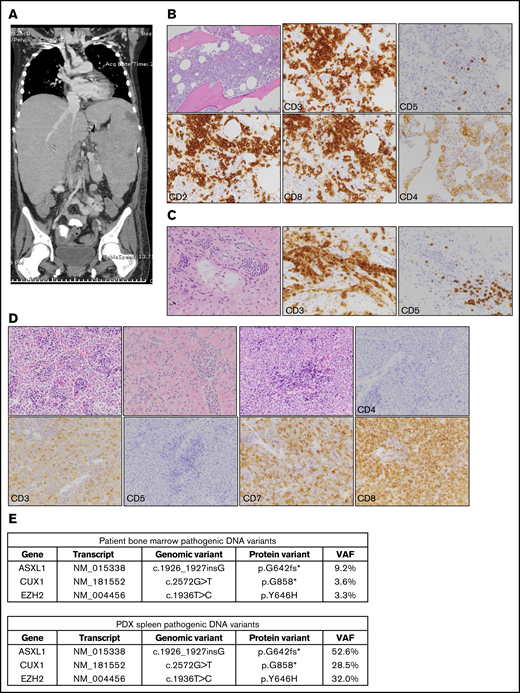 PDX model of HSTL closely recapitulated features of patient’s disease. (A) Coronal image of computed tomography scan of the chest, abdomen, and pelvis of the patient described in the case scenario. (B) Histopathology images of patient’s bone marrow. Top row, left to right: hematoxylin and eosin (H&E), CD3, CD5; original magnification ×200. Bottom row, left to right: CD2, CD8, and CD4; original magnification ×400. (C) Histopathology images of patient’s liver at the time of autopsy. Images from left to right: H&E, CD3, and CD5; original magnification ×400. (D) Histopathology images of the PDX HSTL model; original magnification ×400 for all images. Top row, left to right: H&E, bone marrow; H&E, liver; H&E, spleen; CD4, spleen. Bottom row, left to right: CD3, spleen; CD5, spleen; CD7, spleen; CD8, spleen. (E) Table showing pathogenic variants detected using targeted panel sequencing in both patient bone marrow and PDX spleen. An asterisk (*) identifies a translation termination codon. VAF, variant allele frequency.