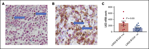 LAG3 expression in DLBCL (A) Case 1. LAG3 (brown) staining in PAX5− TILs (arrows). PAX5 (red) nuclear staining highlights B cells (original magnification ×40). (B) Case 2. Malignant B cells (arrows) show LAG3 expression (PAX5+/LAG3+) (original magnification ×40). (C) Patients with LAG3+ DLBCL cells by IHC had significantly higher total LAG3 mRNA gene counts in their diagnostic biopsies.