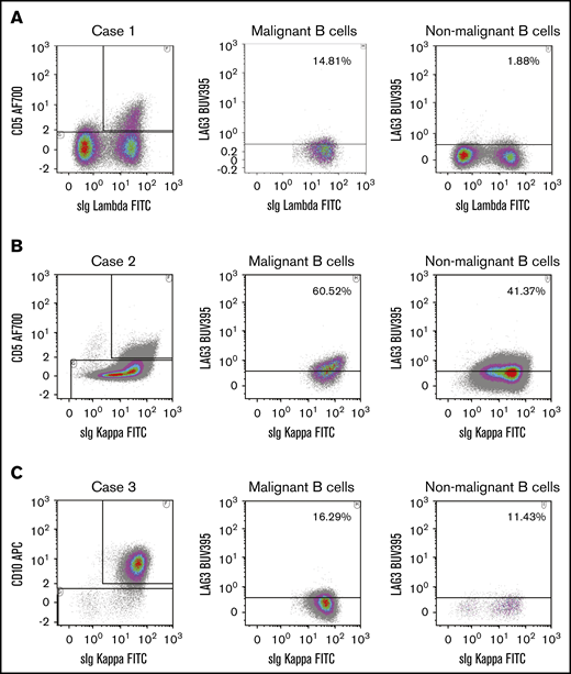 Flow cytometry to detect LAG3 on clonally restricted B cells in DLBCL. Clonally expanded and nonclonally expanded CD20+ B-cell populations were detectable by forward/side scatter, CD10 and/or CD5 λ and κ light chain restriction flow cytometric analysis on fresh frozen deaggregated DLBCL lymph nodes. Representative flow cytometric plots show gating strategies and LAG3 staining in Case 1 (A), Case 2 (B), and Case 3 (C). In each case, clonally expanded CD20+ B cells were distinguished from nonclonally restricted CD20+ B-cell populations by gating on CD5+/κ+(or λ+) or CD10+/κ+ cells. sIg, soluble immunoglobulin.