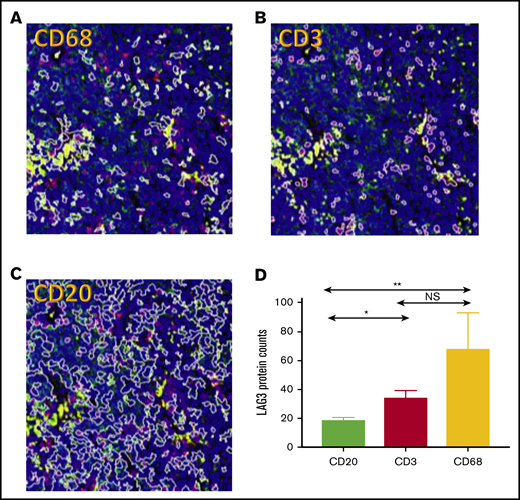 DSP of CD3, CD68, and CD20 regions in DLBCL TME. Representative sample of selected ROIs in 1 case of DLBCL with the same region of tumor demarcated based on CD68 (A; yellow), CD3 (B; red), and CD20 (C; green) ROIs and nuclei/DNA (blue). Original magnification ×20. (D) Average digital counts for LAG3 across all 16 tested cases for CD20, CD3, and CD68, with the CD3 and CD68 ROIs showing significantly higher LAG3 digital protein counts. *P < .05, **P < .01.