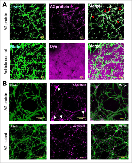 The A2 protein alters and is incorporated into the fibrin clot structure. (A) Representative of 3-dimensional confocal microscopy images of fibrin clots formed in whole blood from a healthy human donor mixed with either vehicle control or the A2 protein (0.5 μM) conjugated to Alexa Fluor 488 (purple). Fibrin was visualized by supplementing whole blood with 1% human fibrinogen conjugated to Alexa Fluor 647 (green). In comparison with the treatment of vehicle control, the A2 protein clearly modified the resultant fibrin structure. In addition, the A2 protein did not interact with the blood cells present in the mixture as compared with vehicle control containing dye only. Colocalization of fibrin and the A2 protein is viewed as a lighter green to white color in the right panel (red arrows). Scale bars, 10 μM. (B) A higher (300×) magnification demonstrates the incorporation of the A2 protein (top middle, purple) into the fibrin structure (top left, green). The white arrowheads point to the A2 protein bound to fibrin branching. In contrast, the A2 mutant did not increment the size of pores (bottom left, green) or formed clusters in fibrin branching (bottom middle, purple). Colocalization of fibrin and the A2 protein is viewed at 300× magnification (top right) as lighter magenta overlapping the fibrin fibers (as lighter green). In contrast, there is less colocalization or overlapping of the A2 mutant with the fibrin fibers (bottom right). Scale bars, 10 μM.
