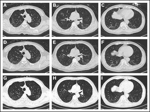 Chest CT images. (A-C) Chest CT imaging on hospital day 2 showed bilateral, multiple ground-glass opacities. (D-F) Chest CT imaging on hospital day 8 showed that the bilateral, multiple ground-glass opacities from the first scan were still there. (G-I) Chest CT imaging on hospital day 19 showed that the range of ground-glass opacities had obviously decreased after use of tocilizumab.