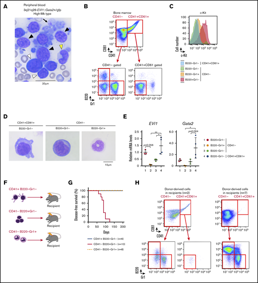 Leukemia in the 3q21q26-EVI1::Gata2+/gfpmice with high platelets has characteristics similar to those of human patients with AML harboring 3q rearrangements. (A) Representative peripheral blood smears (Wright-Giemsa staining) from leukemic 3q21q26-EVI1::Gata2+/gfp mice (High-Mk type leukemia). Note that Blast cells (white arrowheads), myeloid cells (yellow arrowhead), micromegakaryocytes (black arrowheads), and giant platelets (arrow) are observed. (B) Representative flow cytometric profiles of bone marrow cells from leukemic 3q21q26-EVI1::Gata2+/gfp mice (High-Mk type leukemia). CD41– and CD41+CD61+ fractions were further subdivided to assess granulocytic and blast cell characteristics. (C) Representative c-Kit expression profile in each fraction from leukemic 3q21q26-EVI1::Gata2+/gfp mice (High-Mk type leukemia). (D) Wright-Giemsa staining of leukemic cells from 3q21q26-EVI1::Gata2+/gfp bone marrows. (E) Relative mRNA levels of EVI1 and mouse endogenous Gata2 mRNA in each population. B220+Gr1–CD41– (red), B220–Gr1+CD41– (orange), B220–Gr1–CD41– (green), and B220–Gr1–CD41+CD61+ (blue) cells are shown. The abundance of the mRNA was normalized to glyceraldehyde-3-phosphate dehydrogenase. Average values of B220+Gr1–CD41– population were set to 1. Values represent the means ± SD. *P < .05; **P < .01 (1-way ANOVA). (F) Schema for the transplantation analysis; 5 × 104 CD41+B220–Gr1–, CD41–B220+Gr1–, and CD41–B220–Gr1+ cells from leukemic 3q21q26-EVI1::Gata2+/gfp (High-Mk type leukemia, CD45.1/CD45.2 heterozygotes or CD45.1 homozygous) mice were independently transplanted into sublethally irradiated CD45.2 homozygous WT mice. (G) Kaplan-Meier survival curves of WT mice receiving CD41+B220–Gr1–, CD41–B220+Gr1–, and CD41–B220–Gr1+ cells from leukemic 3q21q26-EVI1::Gata2+/gfp mice (High-Mk type leukemia). (H) Representative flow cytometric patterns of the bone marrows of recipient mice receiving CD41–B220+Gr1– cells.