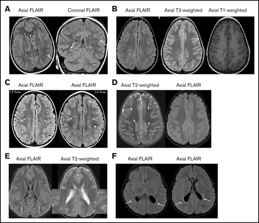 SCI and mimics in SCD. (A) Axial (left) and coronal fluid-attenuated inversion recovery (FLAIR) images illustrate a qualifying silent cerebral infarct in the left parietal lobe (white arrows). An infarct-like lesion was defined as an MRI signal abnormality that was at least 3 mm in 1 dimension and that was visible in 2 planes on FLAIR images or similar image with 3D FLAIR sequence (not shown) and documented neurological examination performed by a neurologist demonstrating that the participant has a normal neurologic examination or an abnormality on examination that could not be explained by the location of the brain lesion(s). (B) Axial FLAIR (left), T2-weighted (middle), and T1-weighted (right) images of the same lesion demonstrate that the FLAIR sequence is better for the identification of SCIs (green circles). (C) Axial FLAIR images show that higher magnet strength (3.0 Tesla) improves image quality and identification of subtle lesions only seen at 3.0 Tesla (arrowhead). More obvious lesions are visible at 1.5 Tesla and 3.0 Tesla (arrows). (D) Linear and punctate T2 hyperintensities that suppress on FLAIR are consistent with prominent perivascular spaces (Virchow-Robin spaces). (E) Terminal zones of myelination on T2-weighted images. Axial FLAIR and T2-weighted images show ill-defined symmetrical T2-weighted hyperintensity in the deep parietal white matter. The T2-weighted image on the right illustrates that there are well-defined linear perivascular spaces extending throughout the area of subtle hyperintensity (green arrows). (F) Axial FLAIR images demonstrate a case of white matter injury in a premature infant (periventricular leukomalacia) that can mimic a SCI because of the increased signal on FLAIR (white arrows).