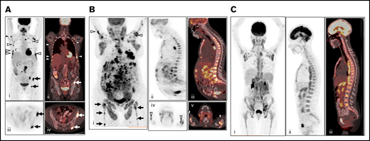 Patterns of FDG uptake in BM. (A) Example of multifocal BM FDG uptake (right humerus, multiple bilateral ribs, and iliac bone) on baseline PET/CT without diffuse FDG uptake, considered positive for BMI (i, maximum intensity projection; ii, coronal fused PET/CT; iii, axial PET; and iv, axial fused PET/CT). (B) Example of multifocal BM FDG uptake (bilateral humeri, femora, and iliac bone) with additional diffuse uptake greater than liver reference on baseline PET/CT, considered positive for BMI (i, maximum intensity projection; ii, sagittal PET; iii, fused PET/CT; iv, axial PET; and v, fused PET/CT). (C) Example of pure diffuse FDG uptake pattern, considered negative for BMI (i, maximum intensity projection; ii, sagittal PET; and iii, sagittal fused PET/CT).