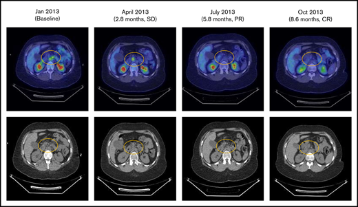 Patients with stage IV Hodgkin lymphoma with complete response (CR) to varlilumab. PR, partial response; SD, stable disease.