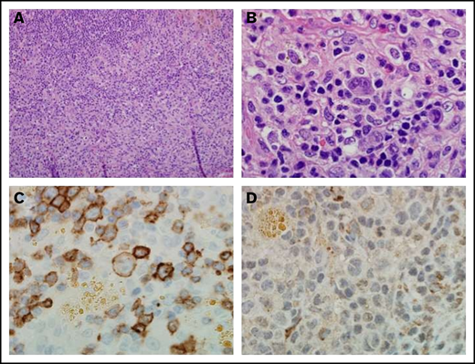Immunohistochemistry of a pretreatment lymph node biopsy sample from a patient with complete response to varlilumab. (A) Hematoxylin and eosin stain (magnification ×20) from a patient with classical Hodgkin lymphoma. (B) Atypical lymphohistiocytic infiltrate within a background of normal reactive cells (magnification ×100). (C) CD27 expression on malignant cells, intratumoral lymphocytes, and histiocytes. Malignant cells and intratumoral T cells were positive for CD27 expression (magnification ×100). (D) CD70 staining was negative on both malignant cells and the intratumoral immune infiltrate (magnification ×100).