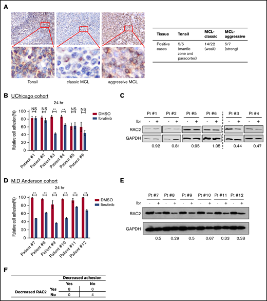 RAC2 expression is enriched in the aggressive subtypes of primary MCL tissues, and RAC2 suppression by ibrutinib is accompanied by reduced cell adhesion. (A) Immunohistochemical staining (400×) shows RAC2 positivity in the mantle zone and paracortex area of benign lymphoid hyperplasia in tonsils, weak scattered positivity in classic MCL tissues, and strong diffuse positivity in pleomorphic MCL. Insets show enlarged photos of individual cells, revealing a cytoplasmic staining pattern. Summary of RAC2 immunostaining in archived primary tissues is shown on the right. (B) Effect of ibrutinib 400 nM on cell adhesion in six thawed primary MCL samples from the University of Chicago (UChicago) cohort. Error bars represent mean ± SEM of 6 replicate reactions. (C) Effects of ibrutinib 400 nM on the RAC2 protein level in the primary MCL cells. For quantification, RAC2 protein levels were first normalized to the loading control glyceraldehyde-3-phosphate dehydrogenase (GAPDH), and RAC2/GAPDH was then normalized to the DMSO control as a ratio. (D) Effect of ibrutinib 400 nM on cell adhesion in 6 thawed primary MCL samples from the MD Anderson cohort. Error bars represent mean ± SEM of 6 replicate reactions. (E) Effects of ibrutinib 400 nM on the RAC2 protein level in the MD Anderson primary MCL samples. For quantification, RAC2 protein levels were first normalized to the loading control GAPDH, and RAC2/GAPDH was then normalized to the DMSO control as a ratio. (F) Summary of the association between decreased RAC2 and decreased adhesion. Numbers represent number of cases. **P < .01.