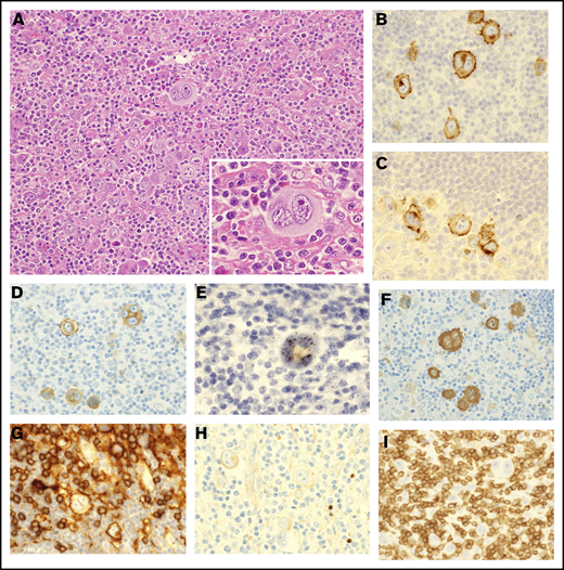 Pathological findings of lymph nodes in ATLL with HTLV-1–infected HRS-like cells. (A) Lymph nodes of case 7 were effaced by infiltration of HRS-like cells (inset) in a background of lymphocytes, histiocytes, and eosinophils (hematoxylin and eosin staining). (B-H) The HRS-like cells were positive for CD30 (B), CD15 (C), CD25 (D), HBZ-ISH (E), fascin (F), and CD4 (G) and negative for PAX5 (H). Most of the infiltrating small lymphocytes were T cells positive for CD3 (I) and negative for HBZ-ISH (E). Original magnification ×200 (A) and ×400 (A, inset, and B-I).