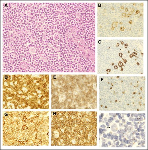 Pathological findings of lymph nodes in ATLL with HTLV-1–infected HRS-like cells and abnormal medium-sized lymphoid cells. (A) In the lymph nodes of case 4, HRS-like cells were surrounded by relatively monotonous medium-sized lymphoid cells with mild nuclear atypia (hematoxylin and eosin staining). (B-C) The HRS-like cells were positive for CD30 (B) and CD15 (C). (D-F) The medium-sized lymphoid cells were positive for CD3 (D) and CD4 (E) but lacked CD7 expression (F), indicating an abnormal T-cell phenotype. (G-H) Both the HRS-like cells and the medium-sized lymphoid cells were positive for CD25 (G), whereas only the medium-sized lymphoid cells were diffusely positive for CCR4 (H). (I) HBZ-ISH revealed that both HRS-like cells and medium-sized lymphoid cells were infected with HTLV-1. Arrow indicates an HRS-like cell. Original magnification ×400 (A-I).