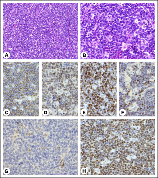 Histopathology of the biopsy specimen. (A-B) Hematoxylin and eosin–stained biopsy specimen. (A) Small vessels are seen. (B) Infiltrating tingible-body macrophages contain only a few apoptotic bodies in the cytoplasm. Original magnification of objective lens ×10 (A) and ×40 (B). (C-H) IHC results for CD20 (C), SOX11 (D), Ki-67 (E), MYC (F), CCND1 (G) by rabbit SP4 (Nichirei Biosciences, Tokyo, Japan) and CCND1 (H) by mouse P2D11F11 (Leica Biosystems, Newcastle Upon Tyne, United Kingdom). Original magnification ×40. (G) Nuclei of histiocytes and endothelial cells were stained positive for the antibody.