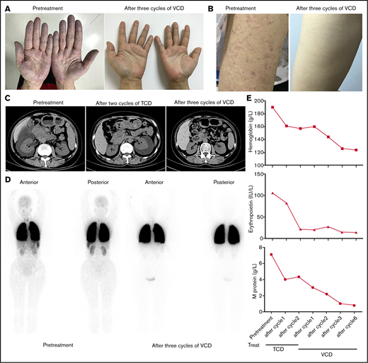Clinical response of patient to treatment with TCD or VCD regimen. (A, B) The disappearance of cyanosis from the patient’s hands (A) and telangiectasias from her arm (B) after treatment with 3 cycles of VCD regimen. (C) Computed tomography scans of abdomen showing resolution of perinephric fluid collections after treatment with TCD and VCD regimen. (D) 99mTc-labeled macroaggregated albumin lung perfusion scintigraphy showing the decrease of intrapulmonary shunting after treatment with 3 cycles of VCD regimen (right side). The presence of intrapulmonary shunting was evidenced by the tracer uptake over the brain, liver, spleen, and kidneys in addition to the lungs. (E) Trend of hemoglobin (upper), erythropoietin (middle), and serum M-protein levels (lower) after treatment with TCD and VCD regimen.