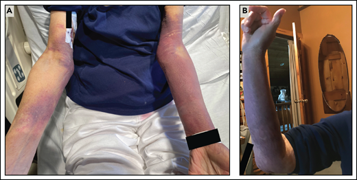 Ecchymoses due to acquired vWD/acquired hemophilia A. (A) In patient 3, left greater than right upper extremity ecchymoses developed on day 4 after dose 2 of the Moderna SARS-CoV-2 vaccine. (B) A similar right upper extremity ecchymosis had spontaneously developed about 1 year earlier. Although laboratory testing at this time was notable for abnormal ristocetin-induced platelet aggregation and a mildly prolonged aPTT, a definitive diagnosis of acquired vWD/acquired hemophilia A was not made until her hospital presentation, as described in case 3.