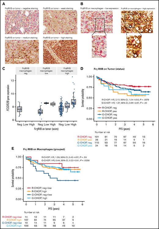Representative IHC staining of tumor TMA and association of FcγRIIB protein expression with PFS for DLBCL patients treated withR-CHOP or G-CHOP in GOYA. TMA sections were stained by IHC for FcγRIIB (brown) and CD68 (red) and assessed by light microscopy. (A) Representative images show ×40 magnification of varying levels of tumor FcγRIIB illustrating negative, weak, medium, and high staining (representative IHC for the Arthur cohort is presented in Arthur et al34). (B) Examples of FcγRIIB on macrophages and corresponding ×63 magnification showing low and high expression. (C) Correlation of FCGR2B expression by RNA-seq with FcγRIIB protein expression on tumor and macrophages. Kaplan-Meier curves for PFS based on FcγRIIB protein expression on (D) tumors* and (E) macrophages.*