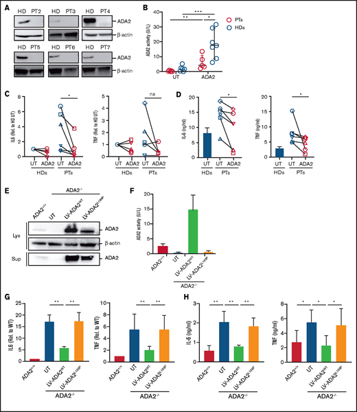 LV-mediated ADA2 correction in patients’ macrophages restored ADA2 enzymatic activity and suppressed cytokine hyperproduction. (A) ADA2 protein expression was assessed in monocyte-derived macrophages from 6 patients with DADA2 and from HDs using immunoblot analysis. β-actin expression was included as a loading control. (B) ADA2 enzymatic activity was measured in cell-free supernatants from patients’ (n = 5) and HDs’ (n = 7) macrophages that were transduced or not with ADA2-LV. IL-6 and TNF expression and release were assessed in UT and ADA2-transduced M1 macrophages from patients and HDs using quantitative reverse transcription polymerase chain reaction (RT-PCR) (C) and enzyme-linked immunosorbent assay (ELISA) (D), respectively. HDs, n = 5; patients, n = 6, with the exception of RT-PCR for TNF expression (n = 5). (E) Immunoblot analysis of ADA2 expression and secretion ADA2+/+ and ADA2−/− U937 macrophages transduced with LV-ADA2 wild-type (ADA2wt) or L188P mutant (ADA2L188P). (F) ADA2 activity was measured in cell-free supernatants from ADA2+/+ and ADA2−/− U937 macrophages transduced with ADA2WT and ADA2L188P. Expression and secretion of IL-6 and TNF were measured in ADA2−/− U937 macrophages expressing ADA2 wild-type or L188P mutant by quantitative RT-PCR (G) and ELISA (H). Data in (F-H) are mean ± standard deviation. *P < .05, **P < .01, ***P < .001. ns, not significant; PT, patient.