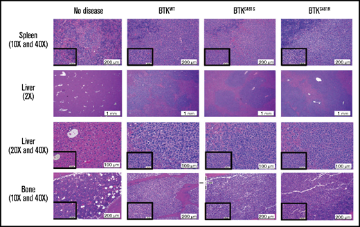 Histopathological assessment of tissues. Histopathologic assessments of hematoxylin and eosin–stained slides were conducted by a veterinary pathologist. Representative images of tissues and lesions of lymphocytic infiltration were captured at the indicated magnifications for the main and inset images. The evaluation results, including the morphologic diagnoses of the organs and the summaries of the mean scores, are provided in supplemental Table 3. Liver and spleen: n = 8/no disease, n = 8/EV, n = 8/BTKWT, n = 9/BTKC481S, and n = 9/BTKC481R. Bone: n = 8/no disease, n = 6/EV, n = 7/BTKWT, n = 6/BTKC481S, and n = 6/BTKC481R.