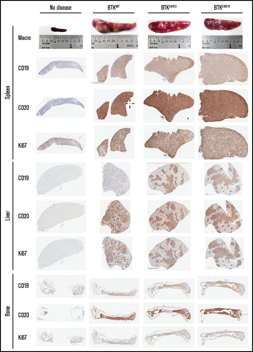 Immunohistochemical analyses of spleen, liver, and bone tissues after the establishment of disease from MEC-1 cells with WT or mutant BTK. Representative macroscopic images of spleens from each group are provided in the top row. Spleen, liver, and bone tissues were collected at the time of euthanasia. B-cell marker expression (CD19 and CD20) and proliferation marker expression (Ki-67) are shown for the spleen, liver, and bone marrow from mice with no disease and from BTKWT, BTKC481S, and BTKC481R mice.