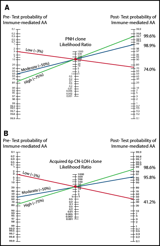 The Bayes theorem/Fagan nomograms demonstrating the pretest and posttest probabilities of immune-mediated AA diagnosis with positive PNH or 6p CN-LOHMHC test results. (A) The Bayes likelihood ratio (LR) nomogram illustrating the predictive value of PNH clones for the diagnosis of AA. PNH clones are ∽100% specific for the diagnosis of immune-mediated AA, and have a positive likelihood ratio of ∽92 for the diagnosis of immune-mediated AA. The patient’s clinical presentation and various clinical factors including age, congenital defects, medications, and comorbidities can influence the estimated pretest probability of immune-mediated AA diagnosis. Shown are 3 examples of patients with a high (75%), moderate (50%), and low (3%) pretest clinical suspicion of immune-mediated AA. Identifying a PNH clone raises the posttest probability of immune-mediated AA to >98% for moderate and high probability patients, allowing clinicians to confidently and efficiently establish a diagnosis of immune-mediated AA. In the patient with a very low suspicion of AA based on other factors, a PNH clone strongly suggests AA diagnosis, with a 74% posttest probability of immune-mediated AA. (B) The Bayes LR nomogram illustrating the predictive value of acquired 6p CN-LOHMHC for AA. Acquired 6p CN-LOHMHC is ∽100% specific for the diagnosis of immune-mediated AA, and has a positive LR of ∽23 for the diagnosis of immune-mediated AA. Shown are 3 examples of patients with high (75%), moderate (50%), and low (3%) pretest clinical suspicion of immune-mediated AA. Identifying an acquired 6p CN-LOHMHC clone raises the posttest probability of immune-mediated AA to >98% for the high probability and to >95% for the moderate probability patients, allowing clinicians to confidently and efficiently establish AA diagnosis. The patient who was previously not suspected of having AA due to various clinical characteristics now has a posttest probability of ∽41% of an immune-mediated AA diagnosis, which should be further considered in the clinical evaluation of this patient.