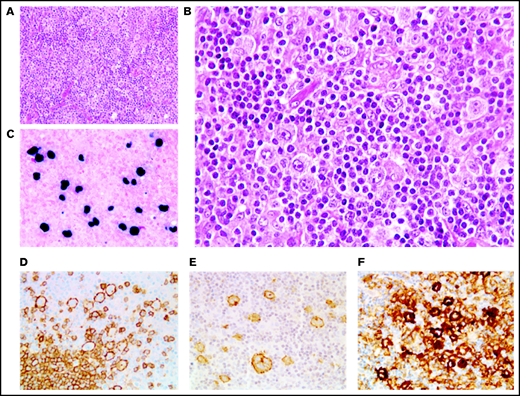 Polymorphic pattern of EBV+ DLBCL-NOS. (A-B) The lymph node architecture is effaced by a proliferation of malignant Hodgkin/Reed-Sternberg-like cells embedded in an inflammatory background. Neoplastic cells express EBER (C) and are positive for CD20 (D), CD30 (E), and PD-L1 (F). Original magnification ×200 (A) and ×400 (B-F).