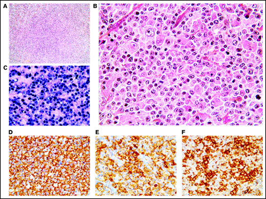 Monomorphic pattern of EBV+ DLBCL-NOS. (A-B) Diffuse proliferation of medium to large centroblastic lymphoid cells. (C-F) All tumor cells express EBER (C), CD20 (D), CD30 (E), and PD-L1 (F). Original magnification ×100 (A) and ×400 (B-F).