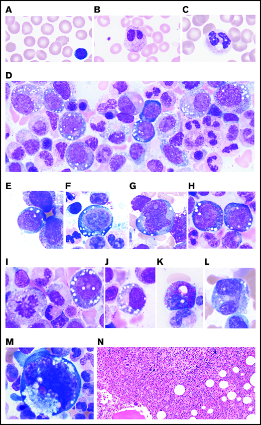 PB and BM features of VEXAS. All patients studied had (A) macrocytic anemia demonstrated by RBCs greater in size than the nuclei of small lymphocytes. (B) Circulating hyposegmented pelgeroid neutrophils and (C) vacuolated neutrophils are common. Bone BM aspirates show striking vacuolization of (D) myeloid and erythroid precursors including (E) blasts, (F) erythroid pronormoblasts, (G) monoblasts, (H-I) promyelocytes, (J) myelocytes, (K) eosinophilic myelocytes, (L) promonocytes, and less commonly (M) megakaryocytes. (N) Core biopsies typically demonstrate hypercellular BM with myeloid hyperplasia (hematoxylin and eosin (H&E) stain; original magnification ×200). (A-M) Wright-Giemsa stained smears; original magnification ×1000.
