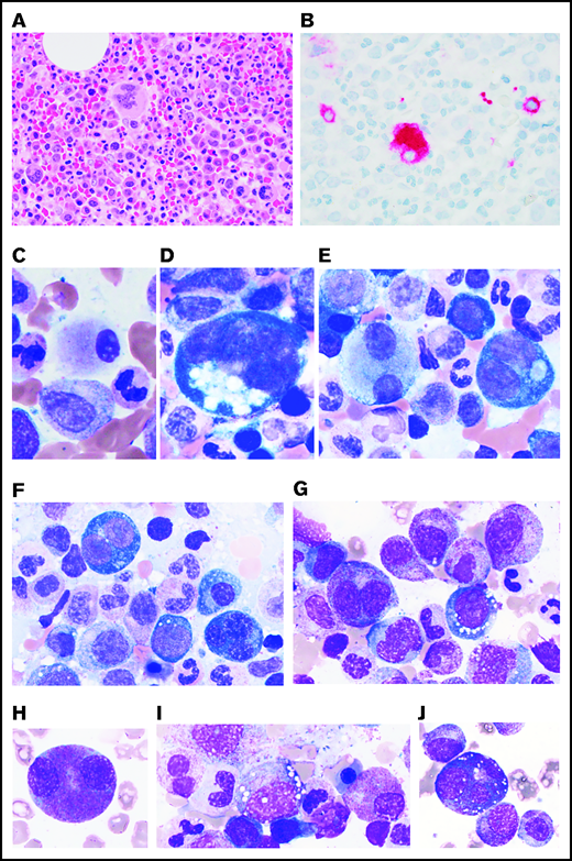 MDS in patients with VEXAS. MDS in patients with VEXAS is associated with hypercellular BM (panel A: H&E stain; original magnification ×500) with dysplastic megakaryocytes, including micromegakaryocytes highlighted by CD61 immunohistochemistry (IHC) on the core biopsy (panel B: original magnification ×500). Dysmegakaryopoiesis can be seen on aspirate smears, including (C) micromegakaryocytes, (D) megakaryocytes with vacuoles, and (E) megakaryocytes with separated nuclear lobes. Dyserythropoiesis including (F-G) binucleation and multinucleation, megaloblastic changes, and nuclear budding are common. Dysmyelopoiesis can be striking with abnormal maturation including (G) binucleation and maturation asynchrony, (H) binucleated eosinophilic myelocytes, (I) hypogranular forms, and (J) myeloid cells with abnormal morphology and vacuoles. All aspirate images show Wright-Giemsa–stained smears; original magnification ×1000.