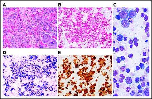 MM in patients with VEXAS. Extensive BM infiltration by markedly atypical plasma cells on core biopsy (panel A: H&E stain; original magnification ×500, inset ×1000 ), highlighted by CD138 IHC (panel B: original magnification ×500). Marrow aspirate showed myeloid precursors with vacuoles and increased scattered plasma cells (panel C: Wright-Giemsa stain; original magnification ×1000). The plasma cells expressed lambda light chains by in situ hybridization on core biopsy (panel D; original magnification ×500) and aberrant expression of cyclin D1 by IHC (panel E: original magnification ×500).