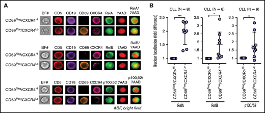 Circulating CLL cells that recently emigrated from the LN in vivo show upregulation of classical/alternative NF-κB signaling. NF-κB nuclear localization was examined in FFWB samples of patients with CLL using imaging FCM (ImageStream). (A) Representative cell images displaying staining for CD5, CD19, CD69, CXCR4, RelA/RelB/p100,52, 7AAD, 7AAD/RelA, 7AAD/RelB, or 7AAD/p100,52 (merge) in a CLL sample. The images were captured at ×60 magnification. (B) Fold difference in nuclear localization of RelA, RelB, and p100,52 in CD69+/CXCR4Low CLL (CD5+/CD19+) cells as compared with CD69−/CXCR4High CLL cells in multiple patient samples. Statistical significance was determined by Student t test. *P < .05; **P < .01; ***P < .001. Data are presented as mean ± SD.