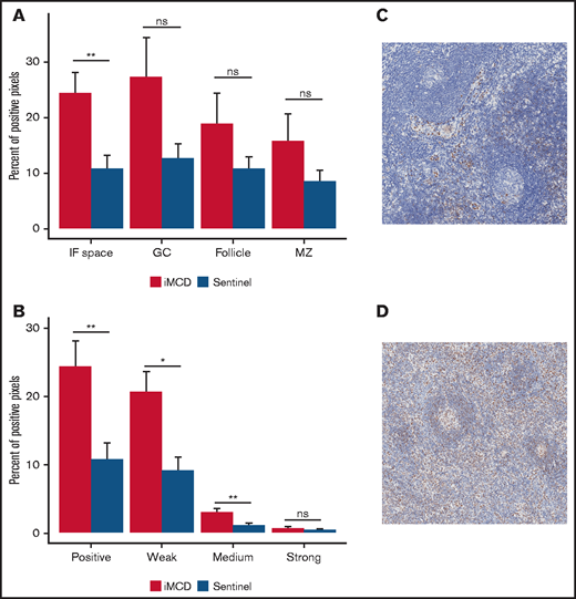 Consistent with enrichment analyses, immunohistochemistry reveals increased pSTAT3 expression in the interfollicular space of iMCD lymph node tissue. (A) iMCD demonstrated significantly more positive staining for pSTAT3 in the interfollicular space compared with normal lymph nodes (P = .0037). No significant differences were observed in germinal centers (P = .2610), secondary follicles (P = .4119), and mantle zones (P = .552). (B) Within the interfollicular space, iMCD lymph nodes demonstrated significantly higher weak (P = .014) and medium (P = .0066) with no difference in strong staining intensity. Representative images of a normal lymph node (C) and an iMCD lymph node (D) (40× magnification) are provided.