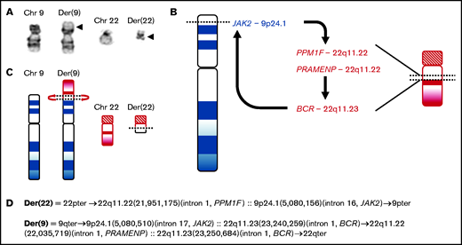 Complex genomic rearrangement resulting in BCR-JAK2. (A) A partial karyotype from a metaphase cell shows an apparently reciprocal translocation between the short (p) arm of chromosome 9 and the long (q) arm of chromosome 22 or a t(9;22)(p24;q11.2). Arrowheads mark the breakpoints on the derivative chromosomes 9 and 22. (B) Genome sequencing defined a more complex rearrangement involving a translocation between 9p24 and 22q11.2 and associated inversion involving 22q11.2. The arrows note the direction of the fusions moving from 5' to 3'. This rearrangement resulted in DNA fusions juxtaposing the intronic regions of BCR-JAK2, JAK2-PPM1F, and PRAMENP-BCR. (C) Idiograms and (D) inferred structure of the derivative chromosomes based on hg38 assembly, NM_014634.4 (PPM1F), NM_004972.3 (JAK2), NM_004327.4 (BCR), and NR_135291.1 (PRAMENP).