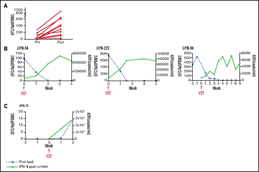 Expansion of adenovirus-specific T cells in peripheral blood of recipients of VSTs by ELISpot. (A) Quantitation of the number of adenoviral T cells before VSTs compared with the peak number in the first 4 weeks after infusion presented as SFCs. Graph shows data from patients with clinical response and an increase in T-cell number after infusion. For patients with multiple infusions, data reflect T-cell increase after the first infusion that resulted in a response. (B-C) Inverse relationship between frequency of circulating VSTs and adenoviral burden. (B) Representative examples of 3 VST recipients who had CRs after infusion with a corresponding increase in T-cell number by ELISpot. (C) ELISpot in 1 patient with no clinical response; note small scale of the y-axis demonstrating minimal T-cell numbers. Open symbols denote number of SFCs per 400 000 PBMCs. Solid symbols denote adenoviral burden in peripheral blood. UPN, unique patient number.