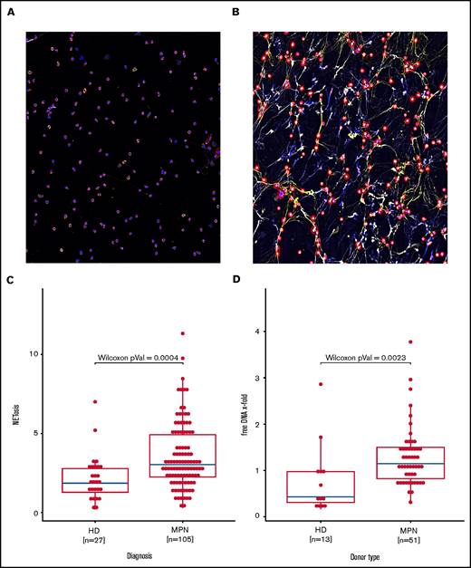 Increased NETosis in patients with MPN vs healthy donors. (A-B) Representative fluorescent imaging of NETs confirming NETosis in primary human neutrophils after 4 hours of exposure to (A) dimethyl sulfoxide and (B) ionomycin 4 µM (original magnification ×40). Antibody staining labeled citrullinated histone H3 red (Cy5, red) and human MPO green (Cy3, yellow); DNA was counterstained with diamidino-2-phenylindole (DAPI) (blue). (C) Induced NETosis rates measured in primary neutrophils from 103 individual MPN patients and 27 healthy donors (HD) by ELISA. (D) Quantification of free DNA in cell culture supernatant from NETosis induction by 4 μM ionomycin demonstrated increased DNA levels in MPN patient samples compared with those from healthy donors. Data are presented as x-fold of vehicle controls. Boxplots show the 25% and 75% quartiles and the median; overlayed dot plots indicate individual measurements.
