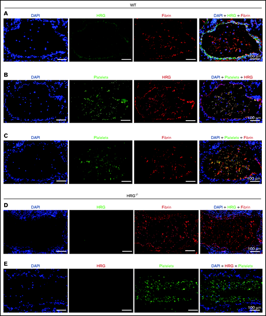 Localization of HRG with platelets and fibrin in pulmonary thrombi. Frozen lung sections harvested from wild-type (WT; panels A-C) or HRG−/− (panels D-E) mice 60 minutes after IP polyP administration were subjected to immunofluorescence using antibodies against HRG, fibrin, and platelets. 4′,6-Diamidino-2-phenylindole (DAPI) was used as a nuclear stain. The combinations for immunostaining were paired as follows: panels A and D, HRG (green) and fibrin/fibrinogen (red); panels B and E, platelets (green) and HRG (red); and panel C, platelets (green) and fibrin/fibrinogen (red). Sections were visualized by using a ×100 objective lens and an Olympus BX41 microscope equipped with a DP72 camera (Olympus, Tokyo, Japan). Scale bars represent 100 μm.