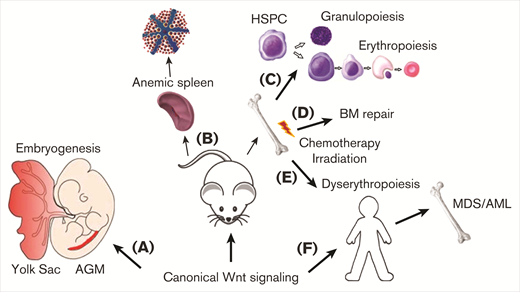 Wnt/β-catenin signaling controls erythropoiesis. Schematic overview reflecting the control of Wnt/β-catenin signaling on erythropoiesis. As reported during primitive hematopoiesis by stimulating primitive erythropoiesis in the yolk sac and by promoting erythroid progenitor formation during definitive hematopoiesis in the AGM region (A). Wnt/β-catenin also stimulates erythroid progenitor formation in the spleen of mice to promote stress erythropoiesis during anemia (B). Additionally, erythroid progenitor formation is supported by Wnt/β-catenin signaling by directing hematopoietic progenitor differentiation toward the erythroid lineage (C) and during BM injury to support recovery of erythropoiesis (D). Constitutive activation of Wnt/β-catenin in the hematopoietic lineage in mice however causes dyserythropoiesis (E), which correlates with MDS development and progression into AML (F).