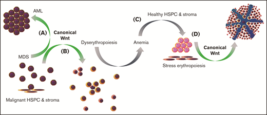 Deregulation of Wnt/β-catenin signaling in MDS. Schematic overview proposing chronic activation of canonical Wnt/β-catenin signaling to promote transformation of MDS to AML (A) and underlie dyserythropoiesis in MDS (B), leading to anemia (C) and triggering stress erythropoiesis by healthy HSPCs and stroma that remain present in the BM (D), which is also promoted by canonical Wnt/β-catenin signaling. Manipulation of canonical Wnt/β-catenin signaling in MDS may therefore, in parallel, alter stress erythropoiesis and increase anemia severity.