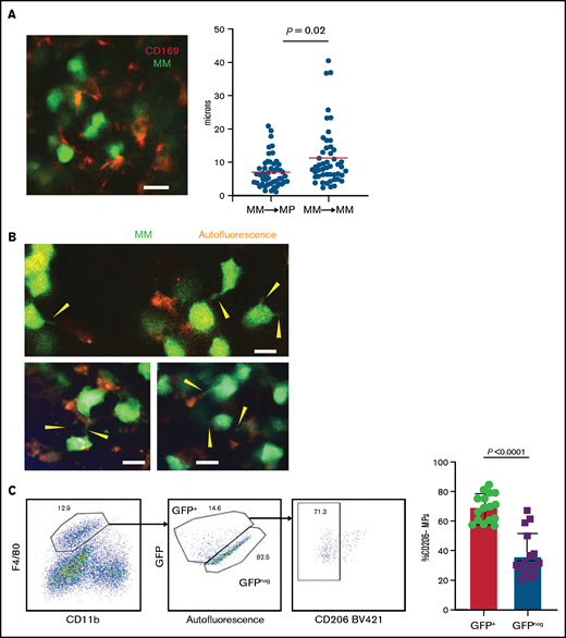 TAMs exhibit proinflammatory phenotype in BM cluster of MM cells. (A-B) Intravital live imaging of GFP+ myeloma cells (green) in the injected tibia at 2 weeks after inoculation (n = 2 mice). (A) 3D analysis of distances between myeloma cells and anti-CD169-PE–labeled MPs (red) within a small cluster. (B) Examples of myeloma nanotube structures extending to BM autofluorescent (MP) cells (red). Yellow arrows show transfer of GFP signals from MM cells to surrounded microenvironment cells. (C) Gating strategy to identify GFP+ and GFP– BM MPs and the CD206 subset and analysis of CD206– (M1-like) subset of GFP+ and GFP– BM MPs in tumor-bearing mice. (D) Kinetics of CD206– MP subset as a function of tumor burden in the BM. (E) Samples of frequency of intracellular IL-6 and TNFα production in MPs, with fold increase in tumor-bearing mice normalized to that of naïve mice, analyzed by a Wilcoxon test. (F) Plot of TNFα-producing BM MPs vs tumor burden in the BM. All experiments were independently repeated at least 2 times; data were pooled and comparisons were analyzed by using a Mann-Whitney t test. Scale bars, 20 μm. *** is P < .001. Errors bars in panel C represent standard deviation. Horizontal lines in panels A and E are mean values.