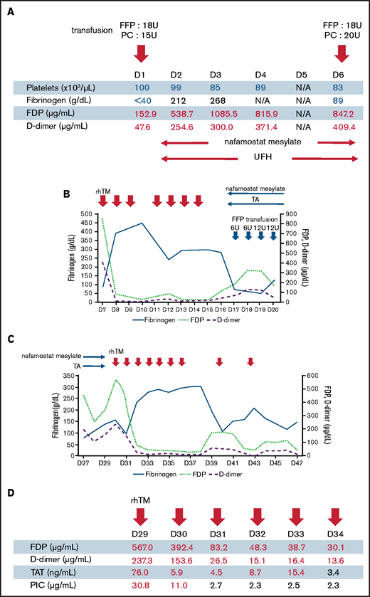 Blood investigation trends. (A) Changes in levels of key blood factors after massive FFP transfusion and hemostatic surgery on day 1 (D1). The patient had a second intra-abdominal hemorrhage on day 6 (D6), requiring another emergency hemostatic surgery. Eighteen units of FFP were also administered after the hemorrhage. (B) Changes in fibrinogen, FDP, and D-dimer levels after rhTM infusions (380 U/kg) administered IV once daily from days 7 through 9 and days 11 through 14. After rhTM infusions were stopped, nafamostat mesylate and tranexamic acid (TA) were administered beginning on day 16. Large FFP transfusions occurred daily from days 17 through 20. (C) The effect of continued nafamostat mesylate and TA treatment followed by reinfusion with rhTM on the levels of coagulation factors over time. On day 36, the daily dosing interval of rhTM was extended to every 2 to 3 days. (D) Changes in levels of key blood coagulation factors followed by infusion with rhTM from days 29 through 34. UFH, unfractionated heparin.