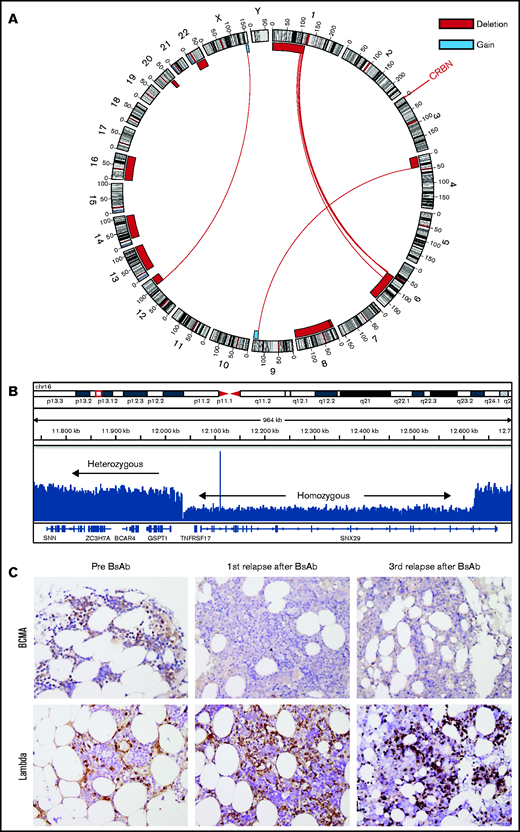 WGS, read coverage track, and immunohistochemistry. (A) Circos plot with copy number variations, structural variations, and single-nucleotide variants based on WGS data at progression after therapy with CD3xBCMA BsAb. Outer track runs clockwise from chromosome 1 to Y. Inner track shows gains >1 Mb in blue and losses >1 Mb in red. Red lines inside the circle represent interchromosomal translocations with variant allele frequency (VAF) >0.1. Genes with mutations (CRBN) are depicted in red. (B) Read coverage visualized with Integrative Genomics Viewer illustrates copy number variations in the short arm of chromosome 16 comprising heterozygous deleted regions caused by monosomy 16 and a homozygous deletion of 586 kb from 12.036.001 to 12.622.000 (hg19 reference genome) including TNFRSF17 (BCMA ). (C) BCMA protein expression was determined by immunohistochemistry using a polyclonal goat anti-BCMA antibody on paraffin-embedded bone marrow sections. Lambda light chain staining (immunohistochemistry) served as positive control (magnification, x200).