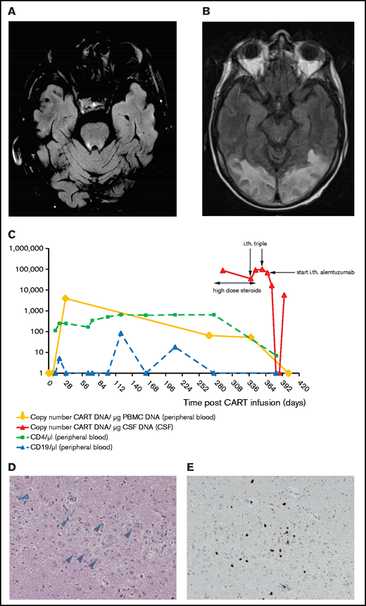 MRI scans, CAR T-cell kinetics in the peripheral blood, and brain histology. (A) MRI scan showing encephalitis in the brain stem and cerebellum. (B) MRI results consistent with PRES. (C) Kinetics of peripheral blood CD4+ and CD19+ cell counts and CAR T-cell expansion in peripheral blood and CSF. (D) Postmortem brain tissue showing severe loss of pyramidal cells in the hippocampus associated with gliofibrillar astrocytosis (blue arrowheads) and macrophage infiltration (red arrowheads). CD68 was used for staining of macrophages/microglia. (E) Postmortem brain tissue showing infiltration of the hippocampal pyramidal layer with CD8+ cytotoxic T cells identified by dark brown peroxidase staining (original magnification ×100). i.th., intrathecal.