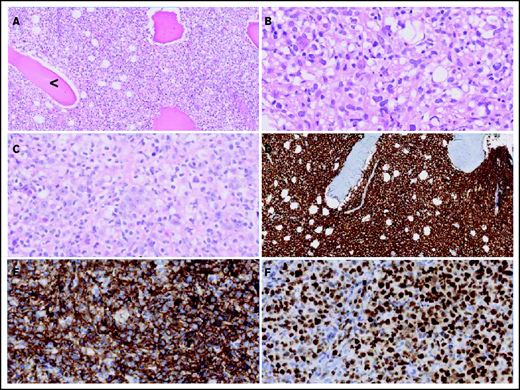 Morphologic and immunohistochemical features of O-DLBCLs. (A) Infiltration of pleomorphic B cells with entrapment of preexisting bone (black arrowhead) in an example of PB-DLBCL. (B) Pleomorphic B cells in a case of PB-DLBCL with large and irregular nuclei with a cleaved, multilobulated appearance and small nucleoli. (C) Pleomorphic B cells in a case of disseminated-DLBCL with large nuclei and prominent large nucleoli with an immunoblastic/plasmablastic appearance. (D) Diffuse staining of CD20 in PB-DLBCL. (E) Diffuse staining of CD10 in an example of PB-DLBCL with a GCB phenotype, according to the Hans algorithm. (F) Strong diffuse staining of MUM1 in an example of disseminated-DLBCL with an ABC phenotype.