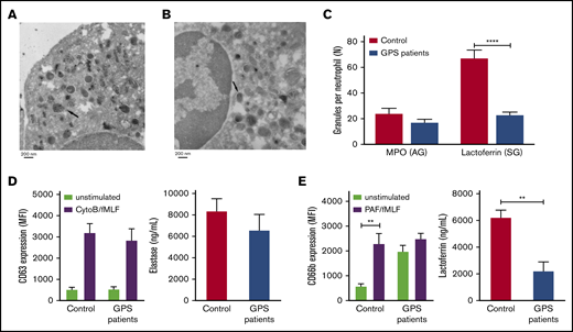 SG deficiency in GPS neutrophils. (A-B) IEM identification of MPO-positive AGs (A) and lactoferrin-positive SGs (B) in GPS neutrophils. The arrow indicates an example of positive granule labeling. (C) The numbers of lactoferrin- and MPO-positive granules per cell were determined by counting the number of positive granules in control and GPS neutrophils. (D-E) Neutrophils from controls and patients with GPS were stimulated with cytochalasin B (5 μg/mL)/fMLF (1 μM) or PAF (1 μM)/fMLF (1 μM), and plasma membrane expression of CD63 (azurophilic; D, left graph) and CD66b (specific; E, left graph) was measured by flow cytometry. The extracellular concentrations of elastase (azurophilic; D, right graph) and lactoferrin (specific; E, right graph) were measured by enzyme-linked immunosorbent assay. Results are means ± SEM, n = 3-5. An unpaired, 2-tailed t test was used. **P < .01, ****P < .0001. MFI, mean fluorescence intensity.